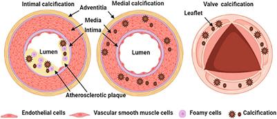 Matrix Vesicles as a Therapeutic Target for Vascular Calcification